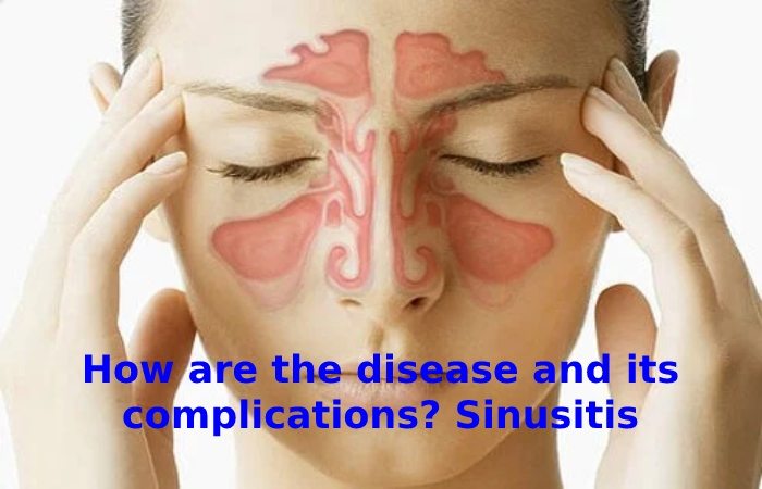 Sinusitis (Sinus) Infection