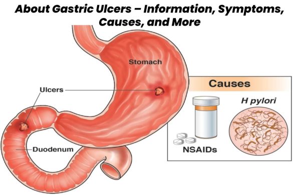 gasteric ulcer