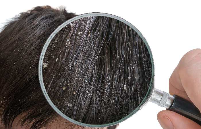 Dandruff ( Pityriasis Capitis )